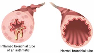 asthma bronchial