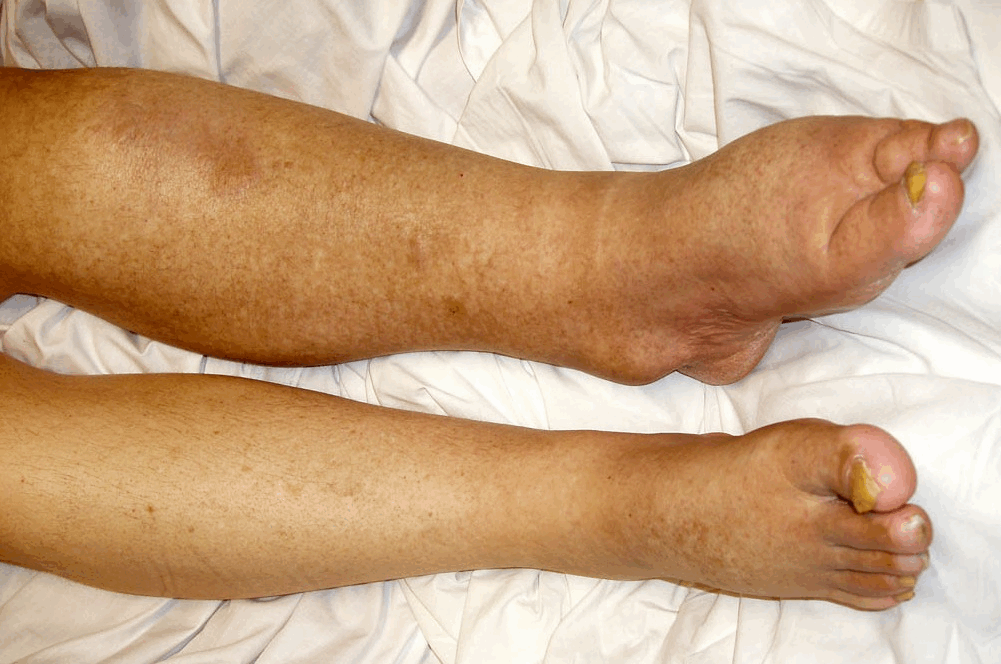 Body Swelling