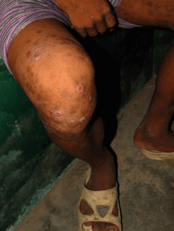 Healed Scabies