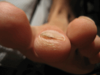 Bacterial Toenail Infection