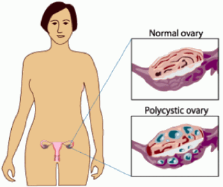 Poly Cysts
